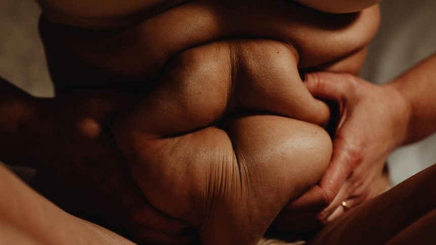 lipedema 1740670093782 1740670094082