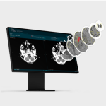 Umjetna inteligencija u ispitivanju učinkovitosti neuroprotektivnog lijeka kod pacijenata s teškim akutnim ishemijskim moždanim udarom