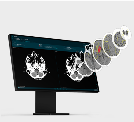 Umjetna inteligencija u ispitivanju učinkovitosti neuroprotektivnog lijeka kod pacijenata s teškim akutnim ishemijskim moždanim udarom