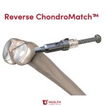 Sveučilište Utah uspješno završilo prvi klinički slučaj s novom reverznom tehnologijom ChondroMatch