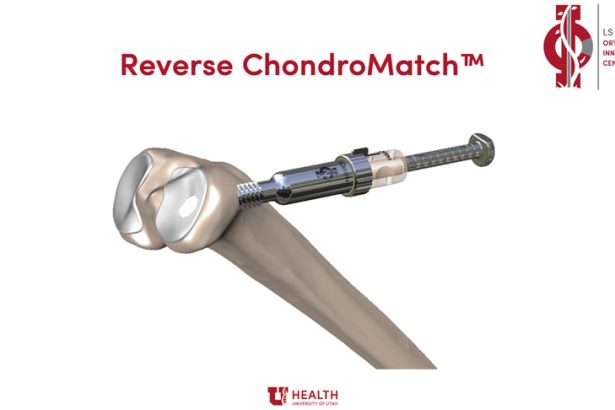 Sveučilište Utah uspješno završilo prvi klinički slučaj s novom reverznom tehnologijom ChondroMatch