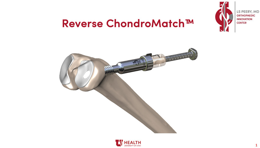 Sveučilište Utah uspješno završilo prvi klinički slučaj s novom reverznom tehnologijom ChondroMatch