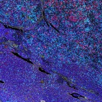 Nova tehnologija omogućava dublje razumijevanje napredovanja raka