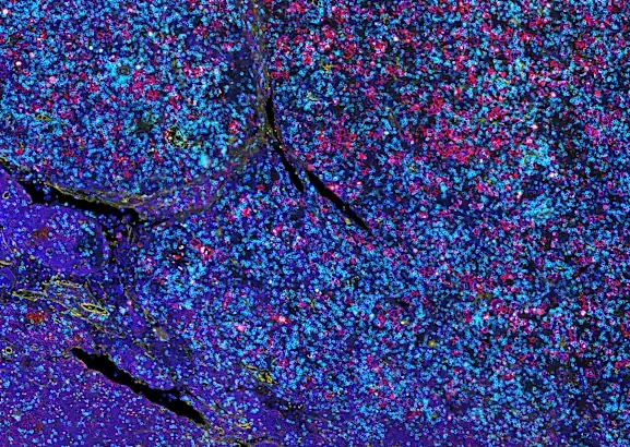 Nova tehnologija omogućava dublje razumijevanje napredovanja raka