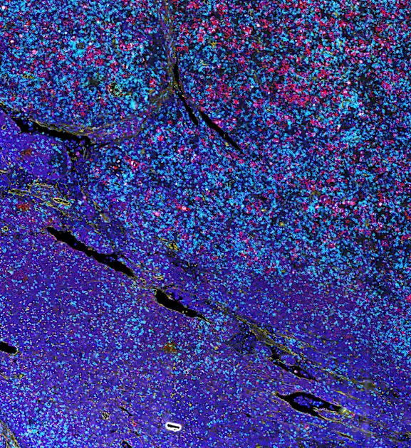 Nova tehnologija omogućava dublje razumijevanje napredovanja raka